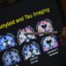 Naturally occurring human peptide shows promise against Alzheimer’s
