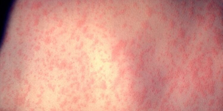 New York launches tracker as measles cases hit 57